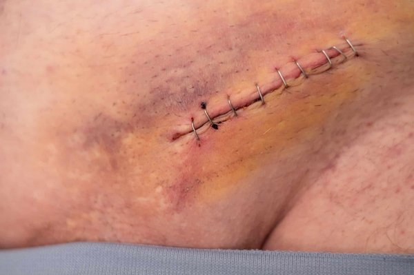 Quelles sont les causes et les moyens de soulager la douleur après une opération de la hernie discale?